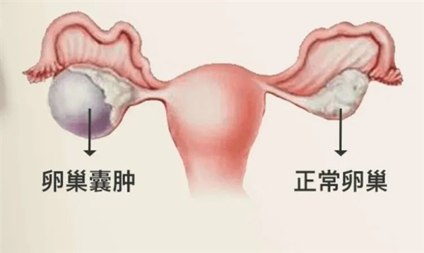 警惕:女子发胖竟是16斤囊肿