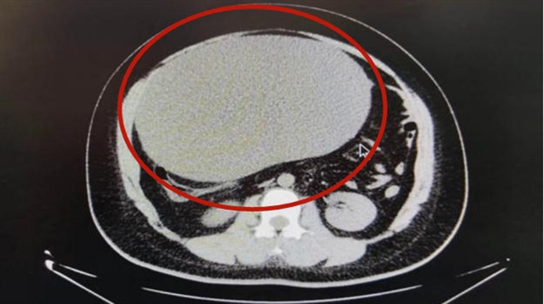 警惕:女子发胖竟是16斤囊肿
