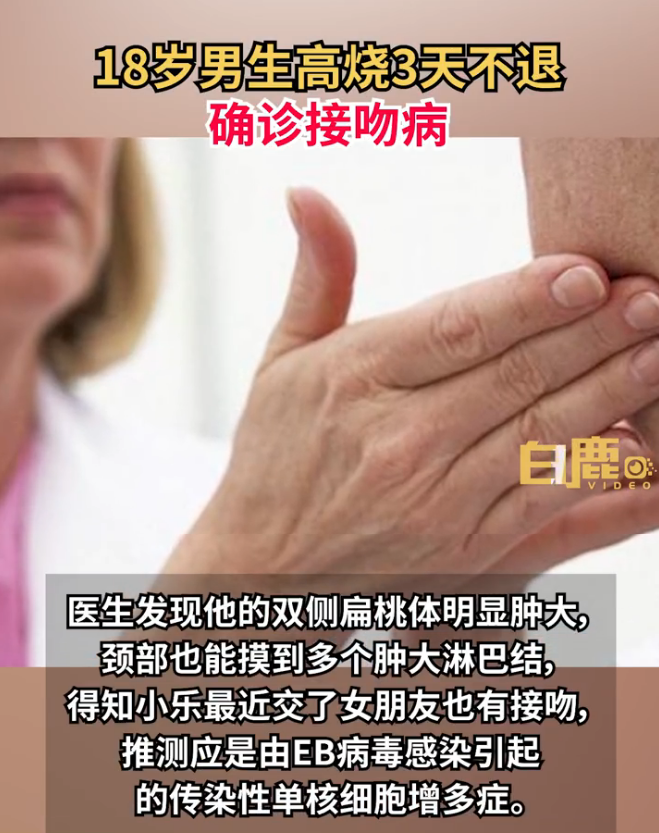 接吻病也叫腺热|接吻病症状