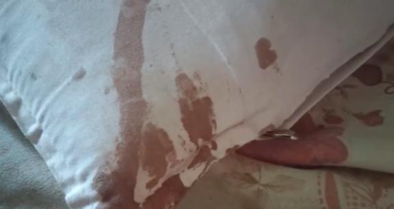 西安一男子睡着了被老鼠咬破