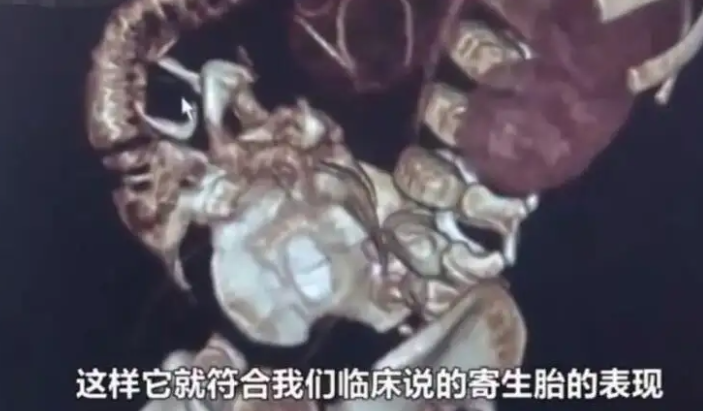 印度8个月女婴体内存在8个寄生胎